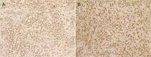 The tumor cells in the primary scrotal mass and the lymph node metastases were strongly immunoreactive for granulocyte-colony stimulating factor (G-CSF) (A) and the G-CSF receptor (B).