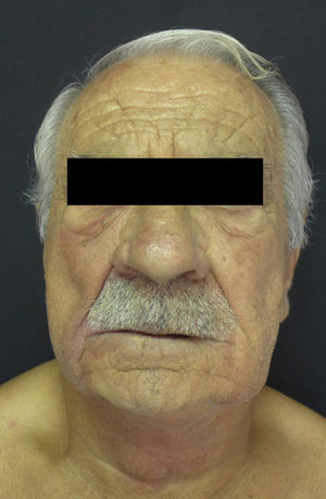 Edema of the neck, left and right malar region, nasolabial folds, and the right infraorbital rim with violaceous coloring.