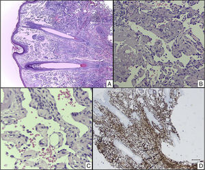 A, Hematoxylin-eosin, original magnification×40. B, Hematoxylin-eosin, original magnification×200. C, Hematoxylin-eosin, original magnification×400. D, CD31, original magnification×40.