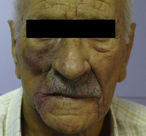 Local progression of the skin lesions with mandibular involvement.