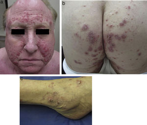 Clinical examination. Grouped crusty inflammatory papules distributed symmetrically on the face (A), hips (B), and ankles (C).
