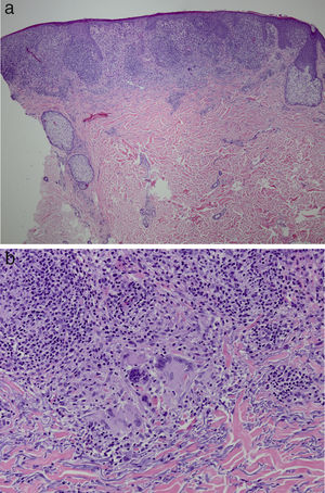 Pathology findings. Epidermal thinning with irregular acanthosis, discrete spongiosis, and parakeratosis. The papillary dermis is replaced almost entirely by granulomas (A) and granulomatous reaction with prominent macrophages and giant cells (B). (Hematoxylin and eosin, x10.).