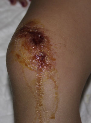 Exudative, vesicular lesions on the knee (Patient 1).