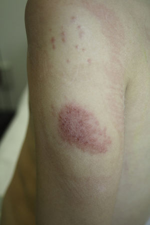 Positive results in an open test (upper) and semiocclusive test (lower) (Patient 1).