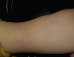 Erythematous papules at the injection site (Patient 2).