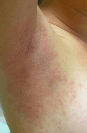 Erythematous, scaly plaques on the axillas.