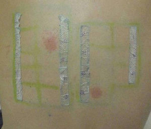 Positive patch test readings to methyl glucose dioleate 5% and balm cream as is, taken at 96hours.