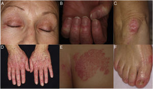 A, Periorbital heliotrope rash. B, Prominent periungual telangiectases. C, Erythematous, scaly plaque on the knee. D, Erythematous, scaly lesions on the dorsum of the interphalangeal and metacarpophalangeal joints. E, Erythematous, scaly plaque on the buttocks. F, Erythematous, scaly lesions on the dorsum and lateral aspect of the feet.