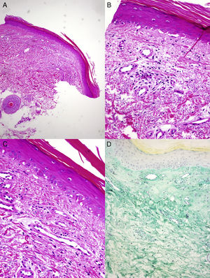 A and B, Histopathology reveals parakeratosis, mild epidermal atrophy, lymphocytic exocytosis, and foci of vacuolization in the basement layer, with occasional apoptotic keratinocytes (hematoxylin-eosin, original magnification×4,×10). C, Vascular proliferation and mild fibrosis in the dermis. No keratinocyte atypia or overexpression of p53 is observed (hematoxylin-eosin, original magnification×20). D, Abundant interstitial acid mucin deposits can be observed (colloidal iron, original magnification×10).