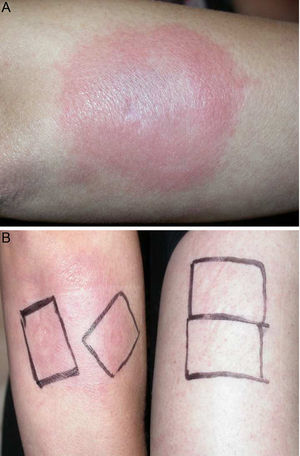 A, Erythematous, edematous plaque on the right forearm that is tender and infiltrated to touch measuring some 10cm in diameter. Patch test with progesterone, which was negative at 96hours, and with NorLevo in petrolatum and Progeffik applied directly on the area of the lesion and on healthy skin (B).