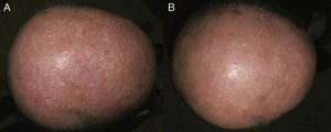 A, Multiple millimeter-sized monomorphous, whiteish papules in the parieto-occipital region. B, Clear improvement of the milia in the parieto-occipital region following application of mild keratolytic agents.