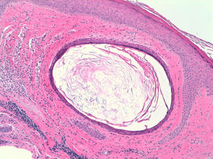 Cyst structure lined by squamous epithelium with a granular and containing orthokeratotic keratin.
