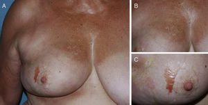 A, Pearly white macules on the right hemithorax and outer quadrants of the right breast. A serosanguineous blister can also be observed beside the right areola. B, Detail of the pearly white macules on the hemithorax. C, Higher magnification of the serosanguineous blister.
