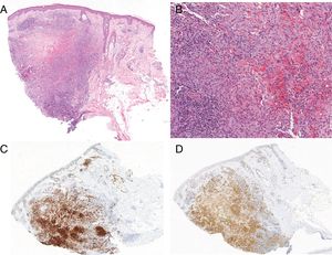 A, Dense, nodular-type infiltrate in the dermis, with areas of necrosis; hematoxylin-eosin, magnification ×10). B, Histiocytes with oval or kidney-shaped nuclei resembling coffee beans and clear cytoplasm; accompanied by lymphocytes and eosinophils (hematoxylin-eosin, magnification ×20). C and D, immunohistochemical staining was positive for S100 and CD1a, respectively.