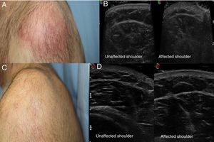 A, Poorly delimited erythematous plaque. B, Ultrasound images showing thickening of the dermis in the affected shoulder, as compared with the unaffected shoulder. C, Resolution of the lesion after treatment. D, Ultrasound images showing the affected and unaffected shoulders after treatment.
