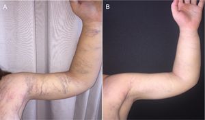 Patient at 16 years of age, before (A) and after (B) treatment of capillary and venous malformations with pulsed dye laser and multiplex neodymium-doped yttrium aluminum garnet (Nd:YAG) laser, respectively.