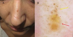 A, Papule of 4 mm on the nasal dorsum. B, Dermoscopic image showing brown globules in the upper half (yellow arrow), yellowish unstructured areas in the lower half (red arrow), and regular linear vessels (red asterisk).