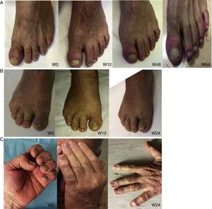 Typical whitening seen in 3 patients with nail psoriasis. W indicates week.