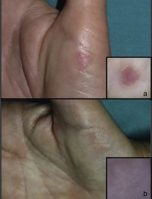 Case 1. Before (A) and after (B) treatment.