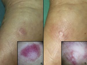Case 2. Before (A) and after (B) treatment.