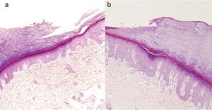 Note the sudden stair-like epidermal thinning in both patients showing a depressed, hypokeratotic epidermal area and hypogranulosis (hematoxylin-eosin, original magnification ×10).