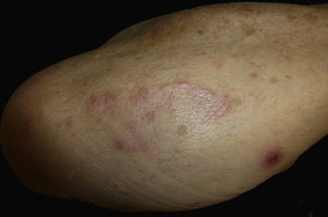 Arciform lesion on the right forearm. Erythematous 0.8-cm plaque with a central crust about 4cm from the main lesion.