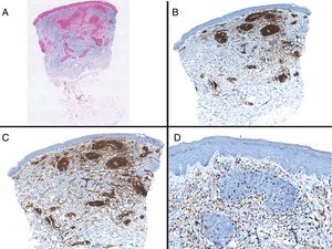 A, Panoramic view of lesion with Alcian blue staining. B, Panoramic view showing the mainly perivascular distribution of CD3+ lymphocytes. C, Panoramic view showing that most T-cell lymphocytes stain positive for CD4. D, Staining with CD68 showing the presence of interstitial macrophages.