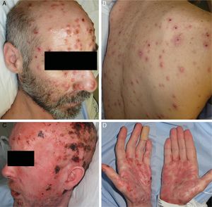 Skin lesions in Patients 1 (A, B) and 2 (C, D).