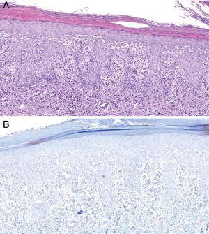 Histology of biopsy from Patient 2. A, Epidermis showing marked spongiotic changes. Predominantly histiocytic inflammatory infiltrate is evident in the superficial dermis (hematoxylin-eosin, original magnification ×100). B, Visualization of abundant spirochetes by immunostaining for Treponema pallidum (Treponema immunohistochemistry, original magnification ×100).
