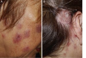 A, Succulent, erythematous-violaceous facial plaques, without surface changes. B, Brownish, desquamative, alopecic erythematous plaque located in the retroauricular area of the scalp.