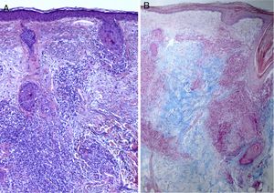Facial skin biopsy showing discrete epidermal atrophy with moderate perivascular and periadnexal lymphocytic infiltrate and abundant deposition of mucin in the dermis. A, Hematoxylin-eosin, original magnification×10. B, Alcian blue, original magnification×4.