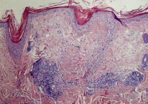 Scalp biopsy showing perivascular and periadnexal lymphocytic dermatitis with epidermal atrophy, parakeratosis, and the presence of horny plugs in the follicular ostia (hematoxylin-eosin, original magnification×20).