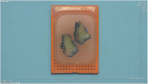 Paraffin block with 2 tissue fragments. The surface of one of them was marked with nail polish, which remained unaffected by all the processing steps and retained its original color.