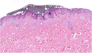 Panoramic view of a lesion marked with the derm dotting technique. The nail polish appears as a gray granular aggregate on the stratum corneum. It neither penetrates the tissue nor changes its structure. (Hematoxylin-eosin, magnification, ×5).