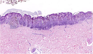 Melanocytic lesions with atypical patterns revealed by dermoscopy are the type of tissue for which derm dotting is most useful. The example in the figure shows how this technique helps to identify very small areas of suspicion. (Hematoxylin-eosin, magnification ×5).