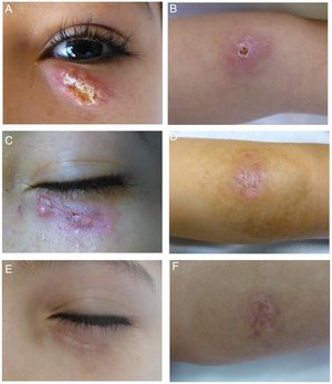 A–B, Lesions caused by Leishmania major before treatment. Note the erythematous oval plaque, the slightly infiltrated borders, and the central crusting on the lower eyelid and left forearm. C–D, Clinical response to 4 sessions of photodynamic therapy. E–F, Response 3 mo after treatment ended.