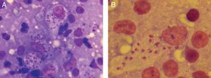 Microscopic views of the smear from the border of the eyelid lesion. A, Macrophages with amastigotes of Leishmania major (Riu
