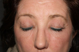 Eczematous lesions at the application sites of the skin lightening product.