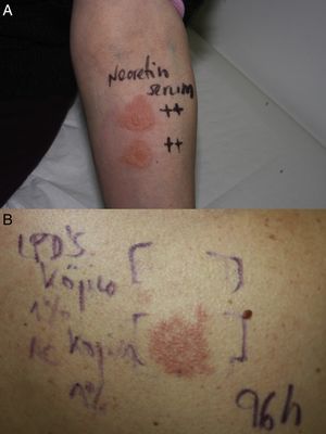 A, Semi-occlusive patch test with the skin lightening product on the patient