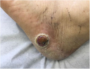 Stony hard tumor with a papillary surface on the lateral aspect of the left foot. Histopathologic findings consistent with a moderately differentiated tubular adenocarcinoma. Integration of these findings with the information from the patient