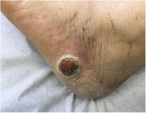 Stony hard tumor with a papillary surface on the lateral aspect of the left foot. Histopathologic findings consistent with a moderately differentiated tubular adenocarcinoma. Integration of these findings with the information from the patient's medical record led to a diagnosis of gall bladder adenocarcinoma.