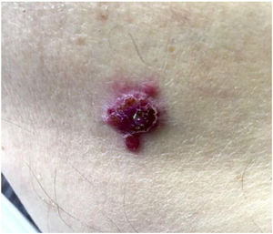 Erythematous tumor with an ulcerated surface on the skin of the right arm. Biopsy findings consistent with a cutaneous metastasis from clear cell renal cell carcinoma. SOX 8+. SOX 8 indicates sex-determining region Y-BOX 8. .