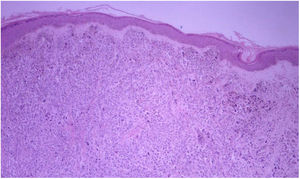 Skin with melanoma metastasis. Hematoxylin-eosin, original magnification ×40. Thin epidermis without melanoma in situ. Dermis invaded by a proliferation of melanocytes arranged in a solid pattern with nests.