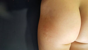 Clinical image. Skin of the lower trunk, hip, and right buttock, with plaques with a mammillated surface, indurated to touch, with no changes in color or hair follicle loss.