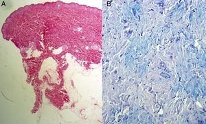 Histology. A, Hematoxylin-eosin staining, ×20: reticular dermis with bands of thickened and dense collagen, without any inflammatory infiltrate. B, Alcian blue staining, ×200: increased mucin in the connective tissue.