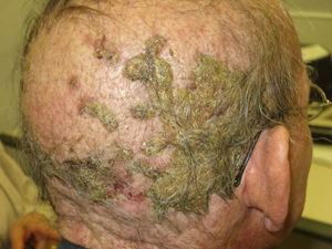 Follicular reaction on scalp caused by cetuximab (anti-EGFR agent), resembling erosive pustular dermatosis of the scalp.