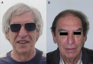 A, Patient with grey hair. B, Same patient with hair repigmentation after nivolumab (anti-PD1) treatment. Courtesy of Dr. N. Rivera.