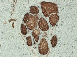 Intense telomerase expression in sebaceous glands (x100).
