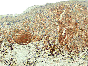 Telomerase expression with a heterogeneous pattern in primary melanoma (x100).