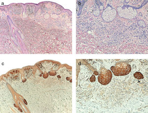 A, Melanoma associated with intradermal nevus (hematoxylin–eosin, x40). B, Detail of intradermal nevus associated with the melanoma (hematoxylin–eosin, x100). C, Intense telomerase expression in melanoma tumor cells and mild expression in nevus cells (x40). D, Detail of mild telomerase expression in the nevus cells (x100).